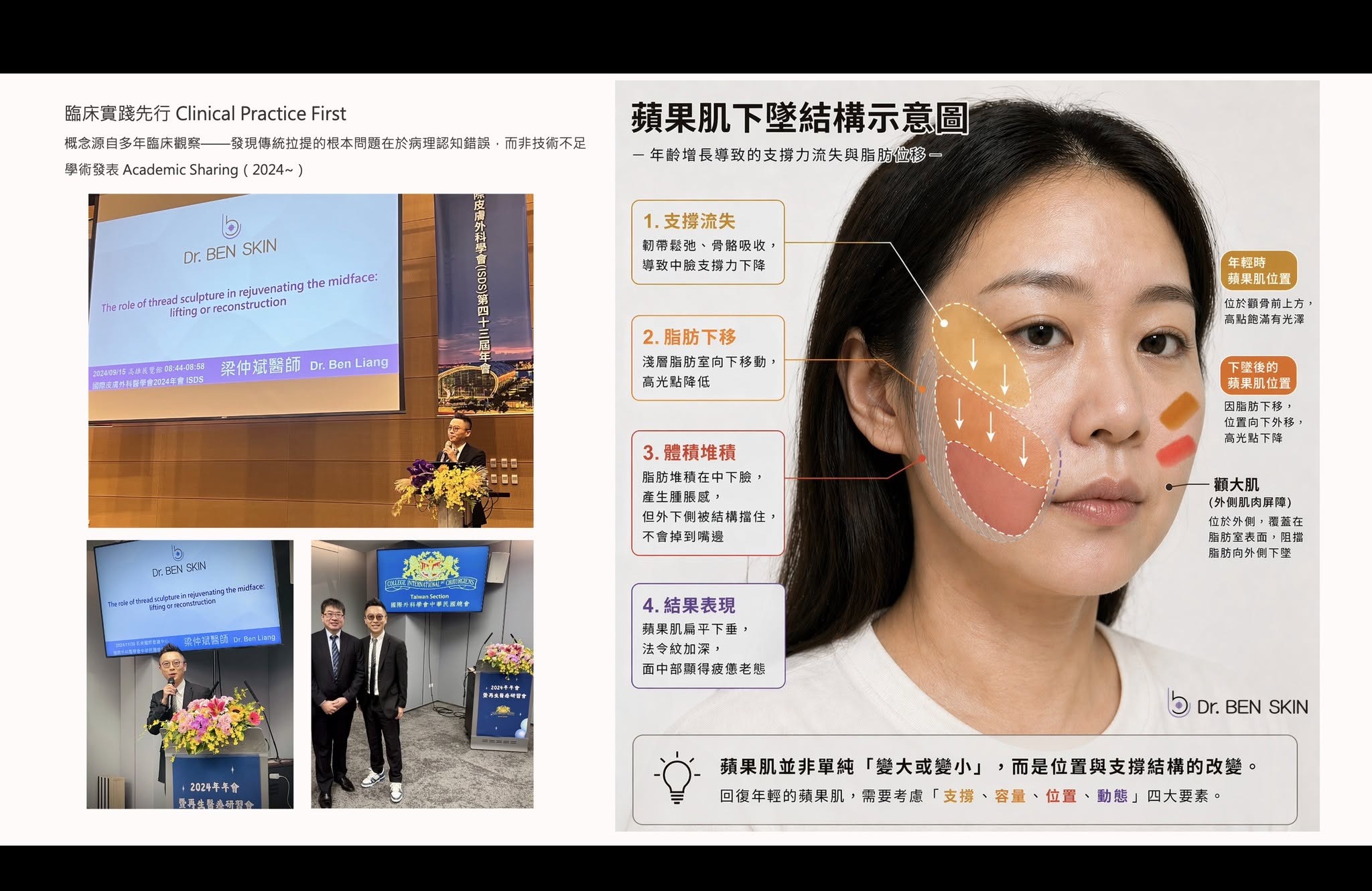 蘋果肌下墜結構示意圖